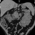 Autosomal dominant polycystic kidney disease (Radiopaedia 36539-38101 Coronal non-contrast 17).jpg