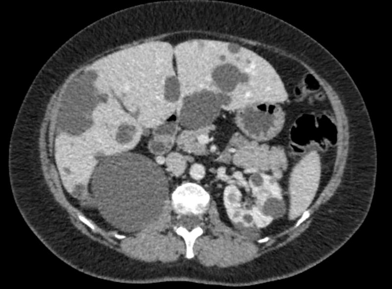File:Autosomal dominant polycystic kidney disease (Radiopaedia 57124-64017 A 48).jpg