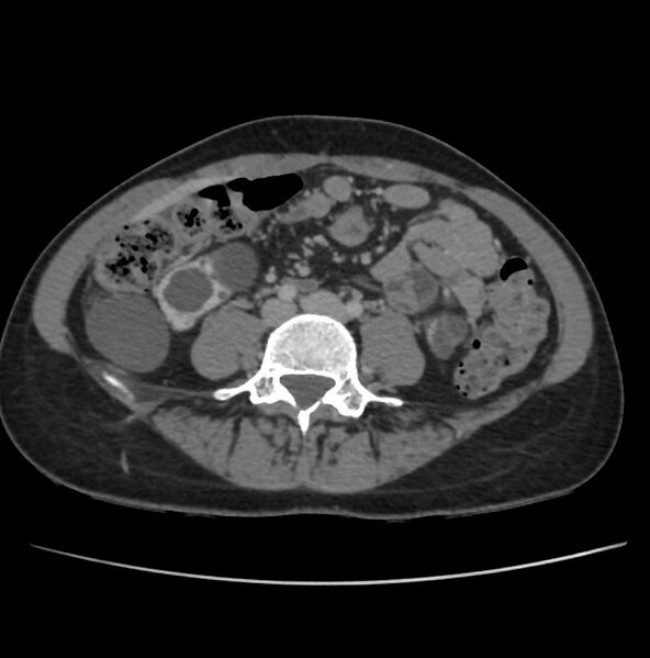 File:Autosomal dominant polycystic kidney disease - early onset (Radiopaedia 40734-43387 A 54).jpg