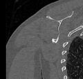 Avulsion fracture - greater tuberosity of humerus (Radiopaedia 71216-81514 Coronal bone window 61).jpg