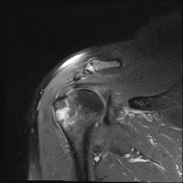 File:Avulsion fracture - greater tuberosity of humerus (Radiopaedia 71216-81515 Coronal PD fat sat 9).jpg