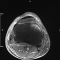 Avulsion fracture of the fibular head (Radiopaedia 74804-85808 Axial PD fat sat 26).jpg