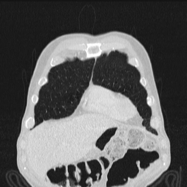File:Azygos lobe (Radiopaedia 38259-40275 Coronal lung window 14).jpg