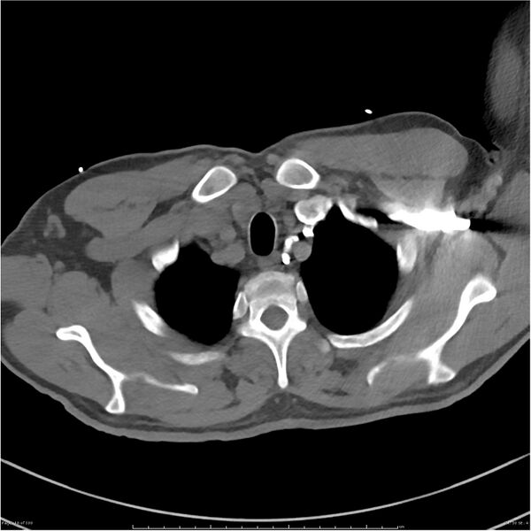 File:Azygos venous system anatomy (CT pulmonary angiography) (Radiopaedia 25928-26077 Axial C+ CTPA 10).jpg
