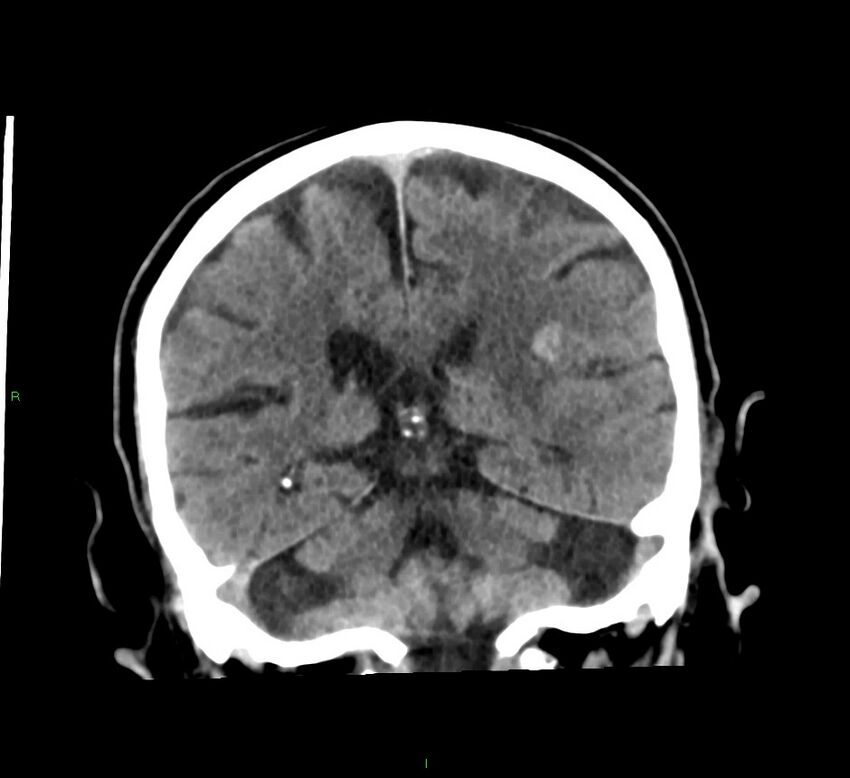 Basal ganglia hemorrhage (Radiopaedia 58791-66025 Coronal non-contrast 25).jpg