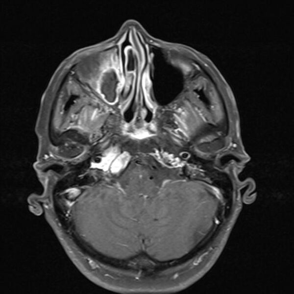 File:Base of skull chondrosarcoma (Radiopaedia 30410-31070 Axial T1 C+ fat sat 8).jpg