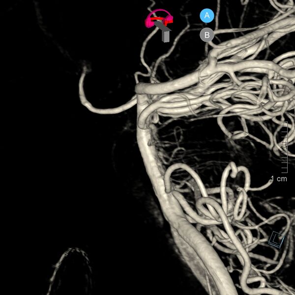File:Basilar artery perforator aneurysm (Radiopaedia 82455-97734 3D view left VA 20).jpg