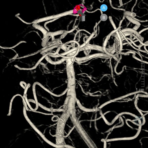 File:Basilar artery perforator aneurysm (Radiopaedia 82455-97734 3D view left VA 3).jpg