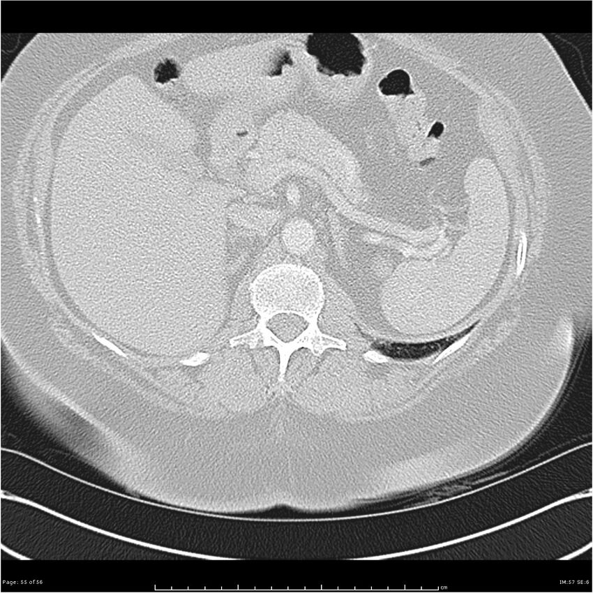 Benign metastasizing leiomyoma (Radiopaedia 26803-26962 Axial lung window 55).jpg
