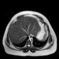 Benign seromucinous cystadenoma of the ovary (Radiopaedia 71065-81300 Axial T2 19).jpg