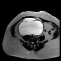 Benign seromucinous cystadenoma of the ovary (Radiopaedia 71065-81300 B 18).jpg