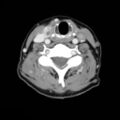 Benign thyroid nodule (Radiopaedia 9414).jpg
