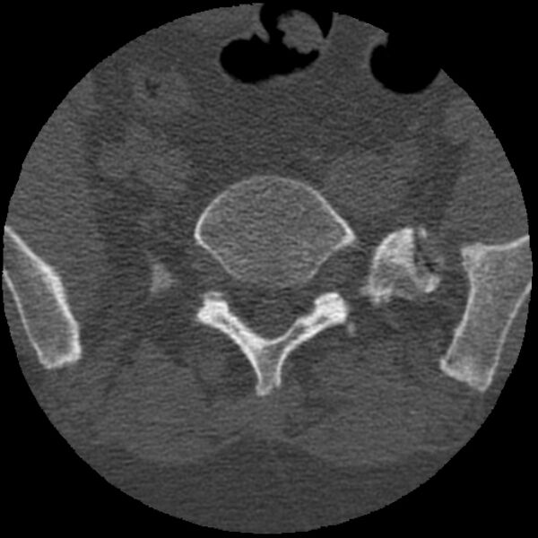 File:Bertolotti syndrome (Radiopaedia 24864-25128 Axial bone window 19).jpg