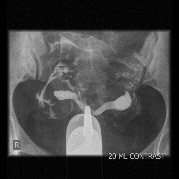 File:Bicornuate-septate uterus (Radiopaedia 59888-67354 B 1).JPEG