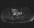 Bicornuate bicollis uterus (Radiopaedia 61626-69616 Axial PD fat sat 21).jpg