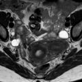 Bicornuate uterus (Radiopaedia 61974-70046 Axial T2 1).jpg