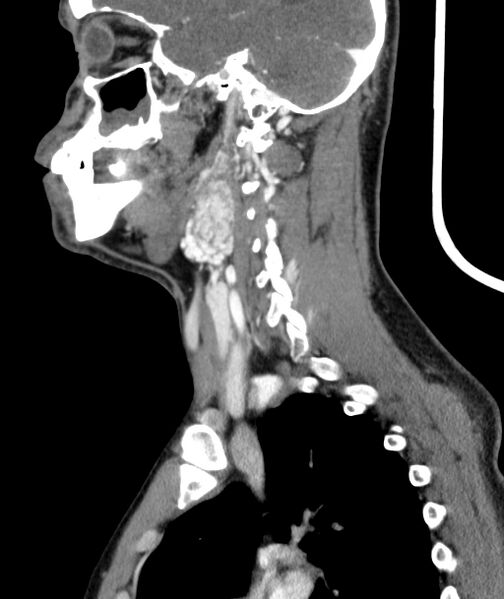 File:Bilateral carotid body tumors (Radiopaedia 52899-58827 C 14).jpg