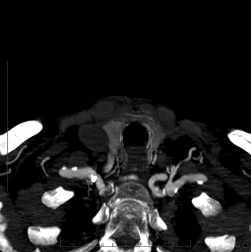 Bilateral chronic common carotid occlusion (Radiopaedia 50849-56362 D 50).jpg