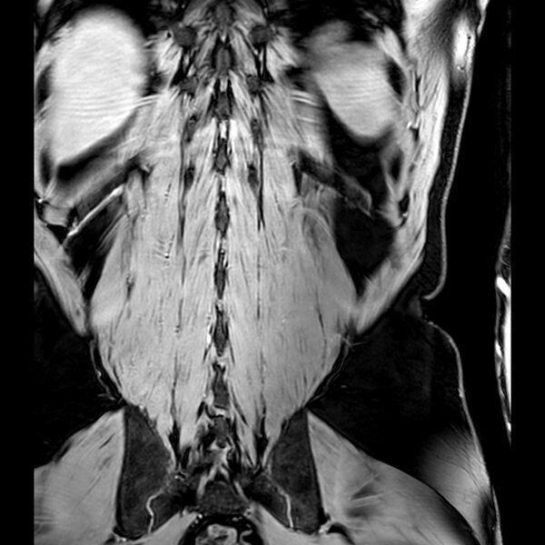 File:Bilateral conjoined nerve roots at different levels (Radiopaedia 73312-84063 B 45).jpg
