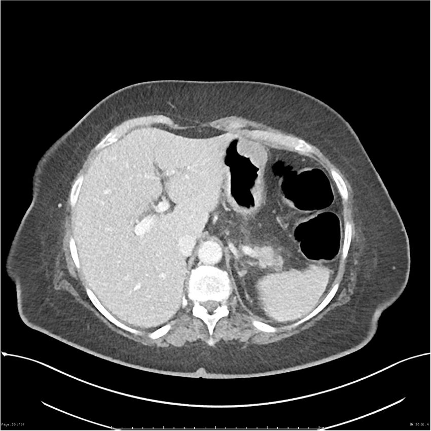 Bilateral psoas hematomas (Radiopaedia 24057-24279 A 20).jpg