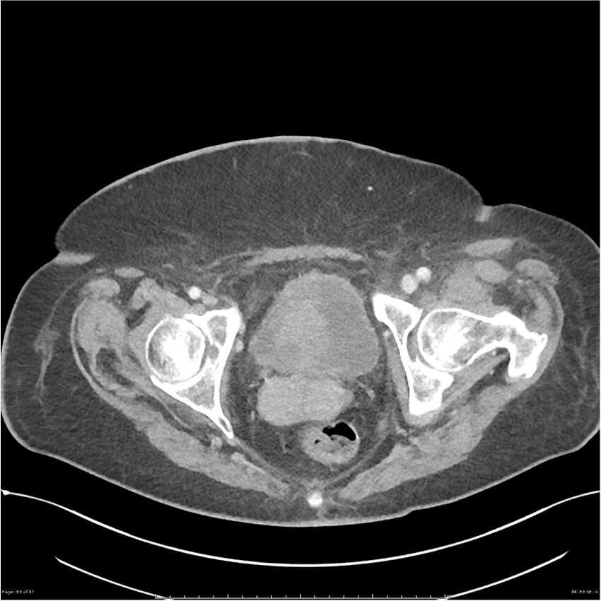 Bilateral psoas hematomas (Radiopaedia 24057-24279 A 83).jpg