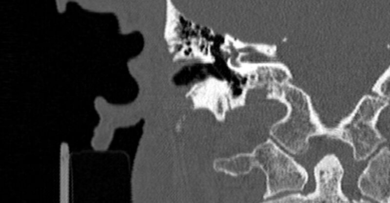 File:Bilateral temporal bone fractures (Radiopaedia 29482-29970 Coronal non-contrast 108).jpg
