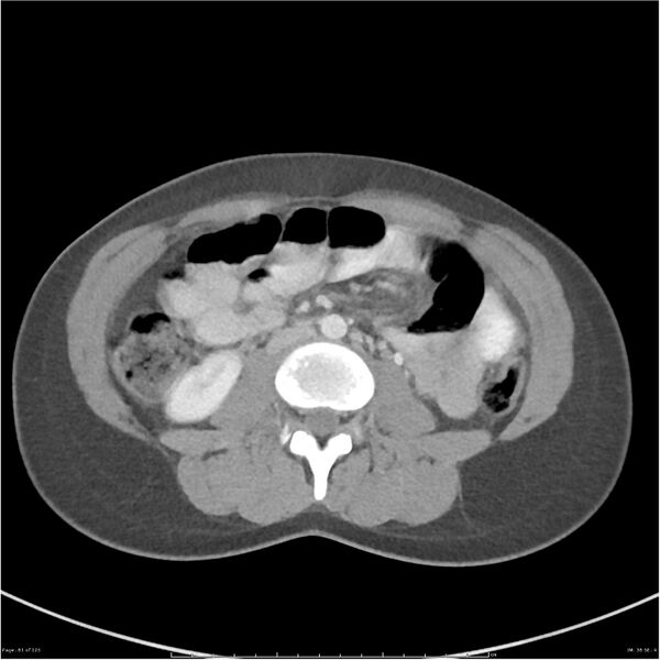 File:Bilateral ureteritis and cystitis (Radiopaedia 25340-25594 A 38).jpg