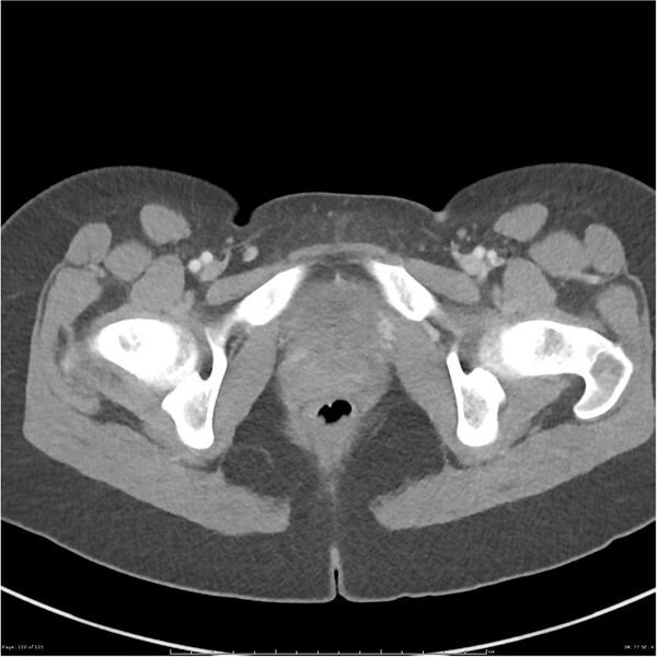 File:Bilateral ureteritis and cystitis (Radiopaedia 25340-25594 A 77).jpg
