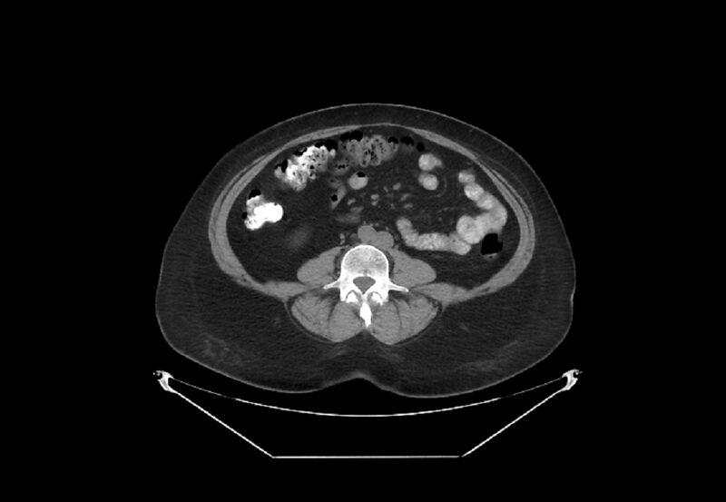 File:Bilateral urolithiasis with incidentally detected splenic artery aneurysm and left inferior vena cava (Radiopaedia 44467-48123 Axial non-contrast 33).jpg