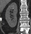 Bile leak from accessory duct(s) of Luschka post cholecystectomy (Radiopaedia 40736-43389 B 56).jpg