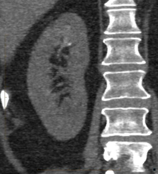 File:Bile leak from accessory duct(s) of Luschka post cholecystectomy (Radiopaedia 40736-43389 B 56).jpg