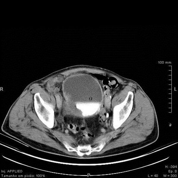 File:Bladder squamous cell carcinoma (Radiopaedia 14130-13984 C 6).jpg