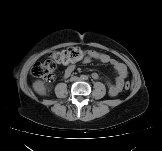File:Bosniak renal cyst - type IV (Radiopaedia 22929-22953 Axial non-contrast 35).jpg