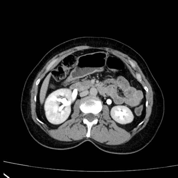 File:Bosniak renal cyst - type I (Radiopaedia 27479-27675 D 20).jpg