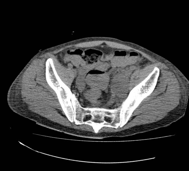 File:Bowel lymphoma complicated by bleeding after therapy (Radiopaedia 55601-62110 Axial non-contrast 68).jpg