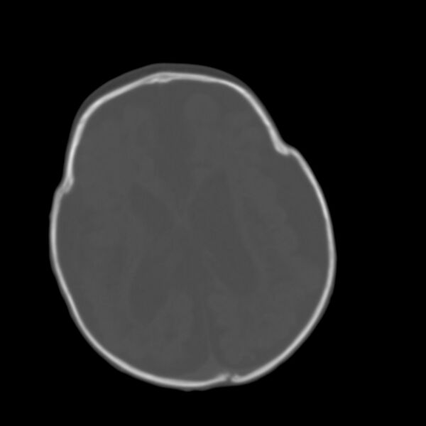 File:Brachycephaly (bi-coronal and bi-lambdoid synostosis) (Radiopaedia 55048-61413 Axial bone window 12).jpg