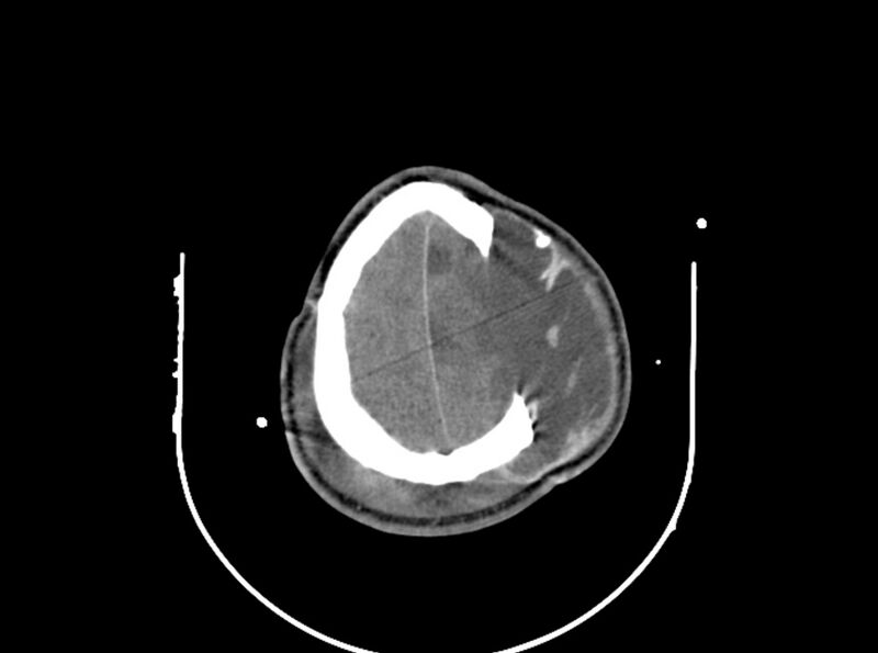 File:Brain injury by firearm projectile (Radiopaedia 82068-96087 B 158).jpg