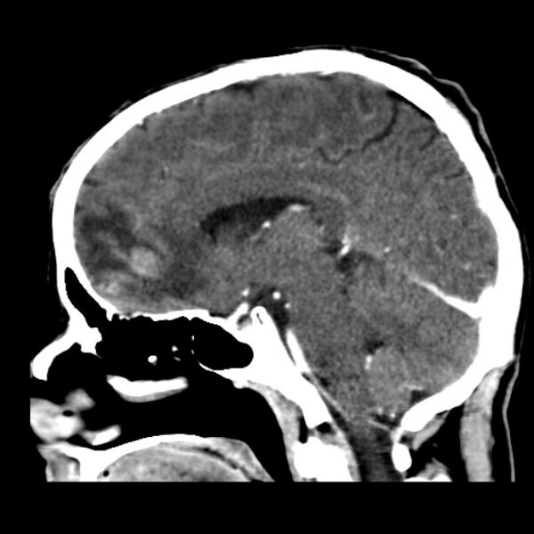 File:Brain metastases from lung cancer (Radiopaedia 24480-24781 C+ delayed 32).jpg