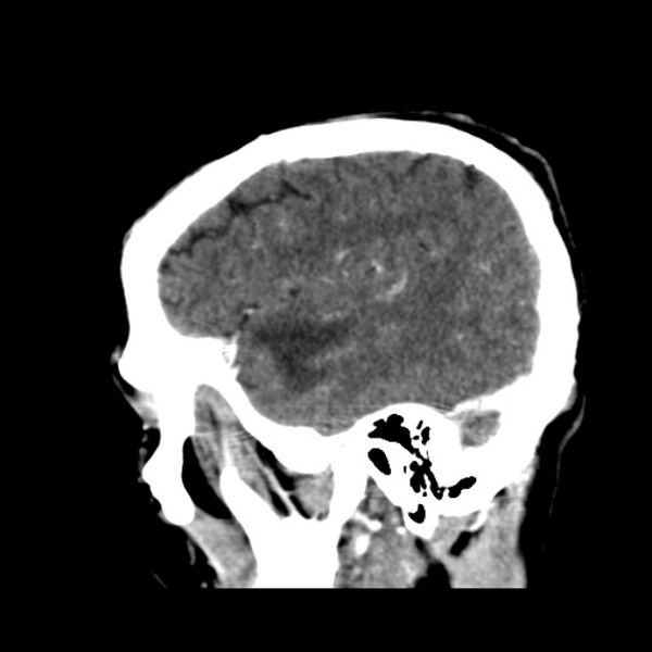 File:Brain metastases from lung cancer (Radiopaedia 24480-24781 C+ delayed 47).jpg