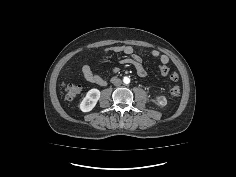 File:Brain metastases from renal cell carcinoma (Radiopaedia 42222-45328 A 150).jpg