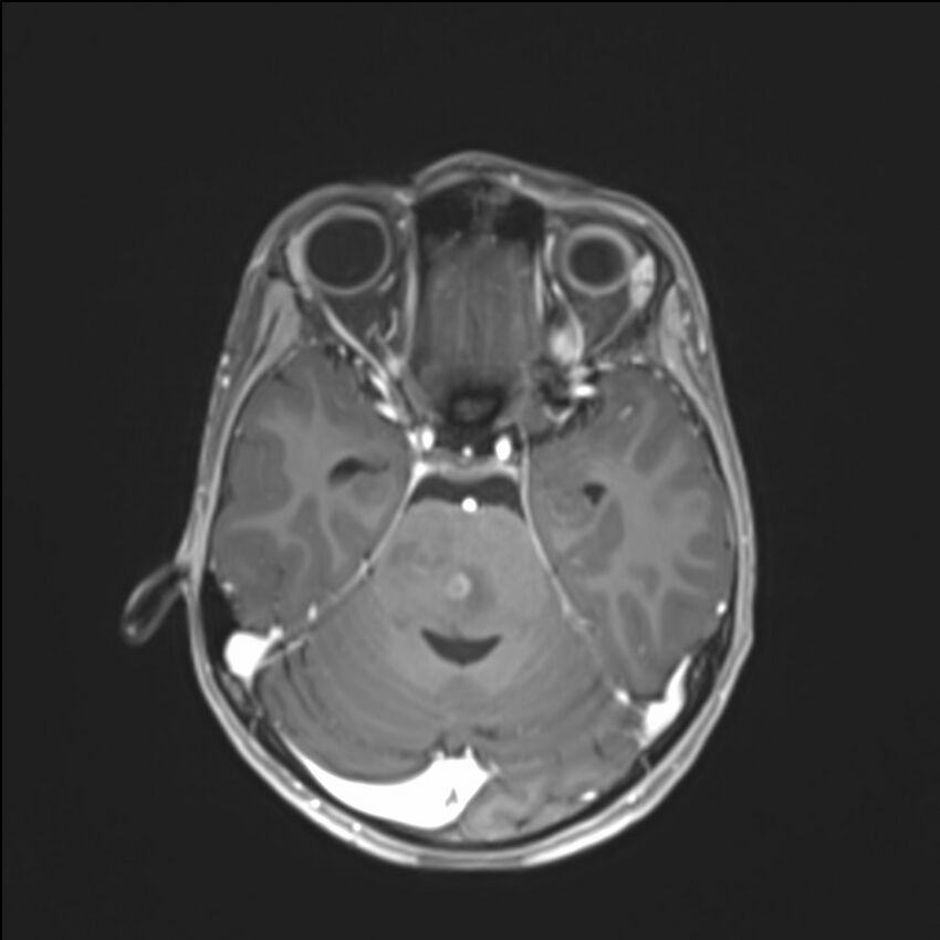 Brainstem glioma (Radiopaedia 70548-80674 Axial T1 C+ 58).jpg