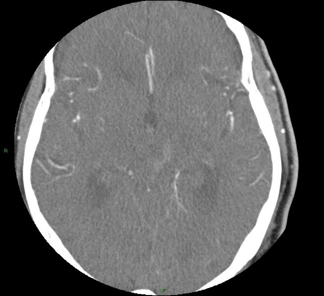 File:Brainstem hemorrhage (Radiopaedia 58794-66028 D 90).jpg