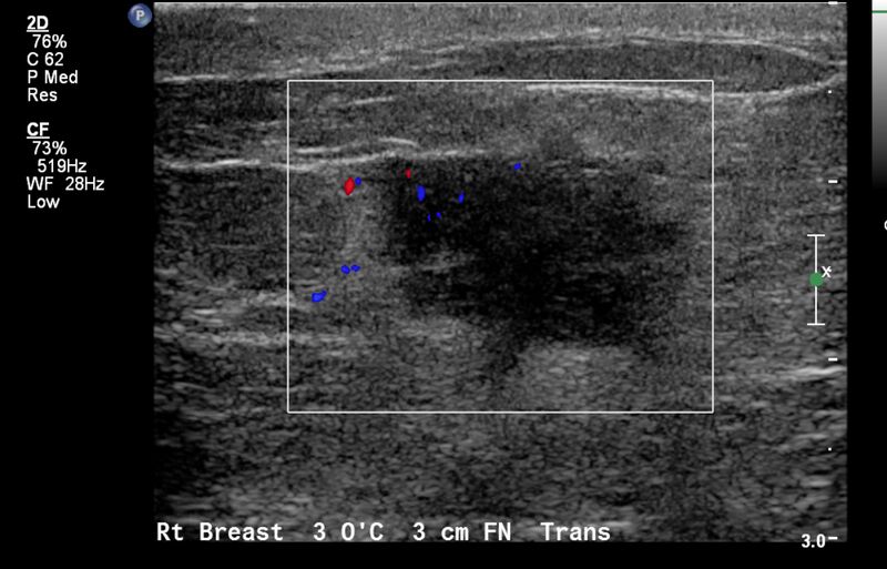 File:Breast cancer and multiple circumscribed masses (Radiopaedia 62456-70700 A 3).jpeg
