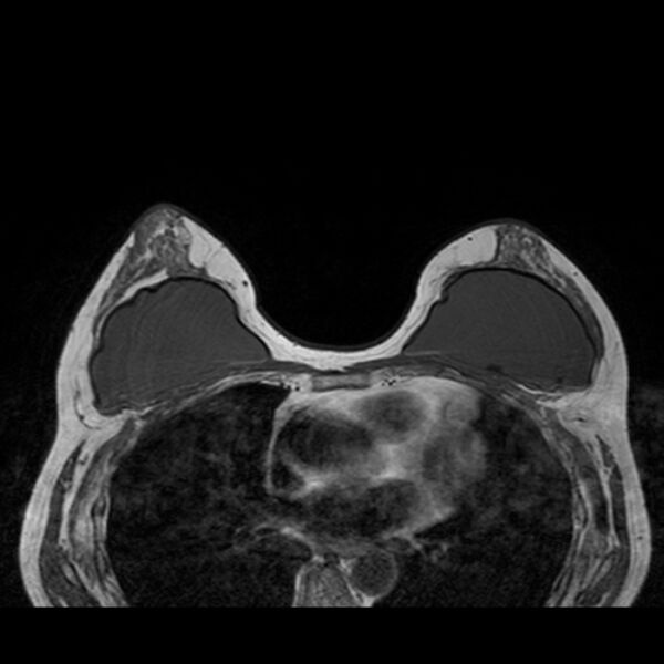 File:Breast implants - MRI (Radiopaedia 26864-27035 Axial T1 27).jpg