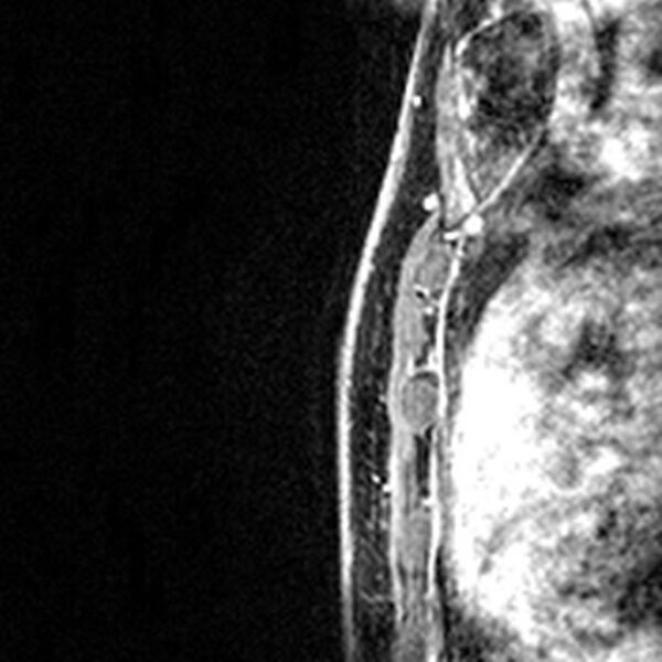 File:Breast implants - MRI (Radiopaedia 26864-27035 Sagittal T2 53).jpg