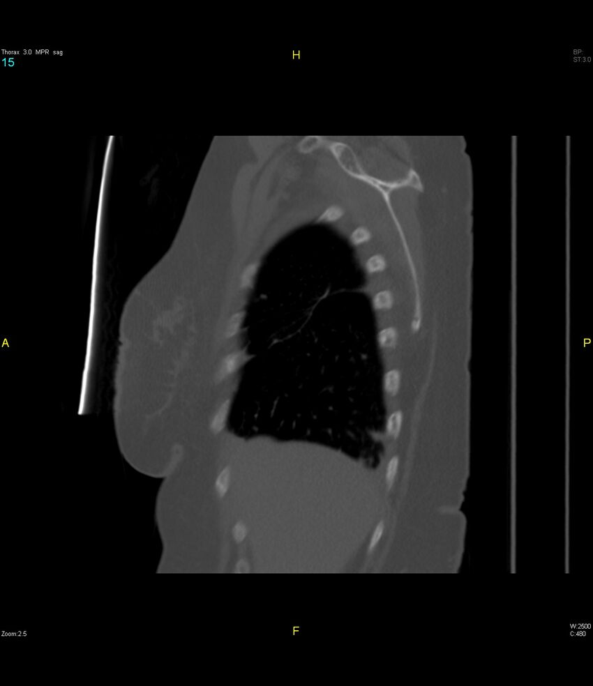Breast primary with lung and bone metastases (Radiopaedia 40620-43228 Sagittal bone window 15).jpg