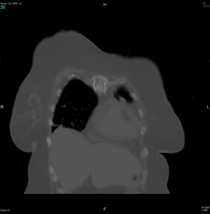 Breast primary with lung and bone metastases (Radiopaedia 40620-43228 bone window 20).jpg