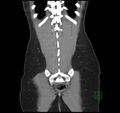 Broad ligament hernia (Radiopaedia 63260-71832 B 34).jpg