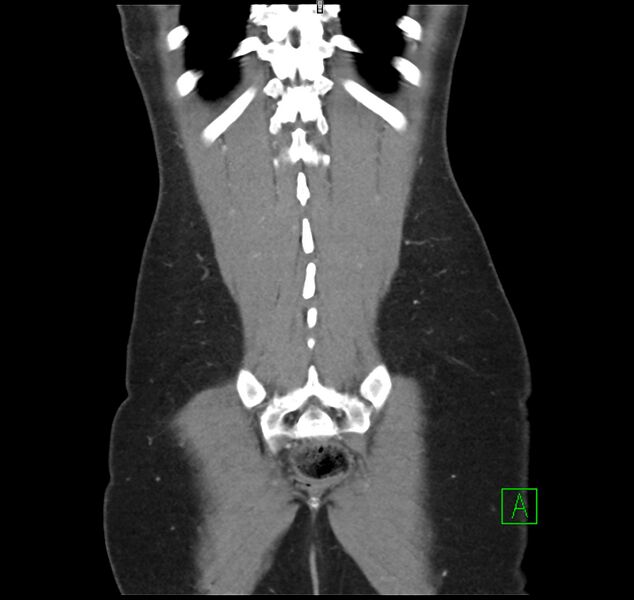 File:Broad ligament hernia (Radiopaedia 63260-71832 B 34).jpg