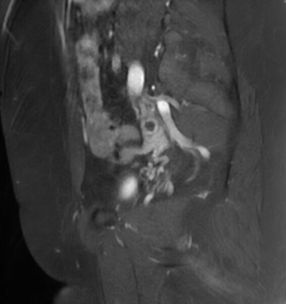 File:Broad ligament leiomyoma (Radiopaedia 81634-95516 G 22).jpg
